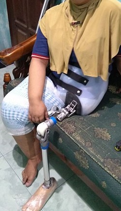kaki palsu amputasi panggul
