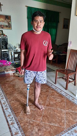 fitting kaki palsu atas lutut harga 8juta an